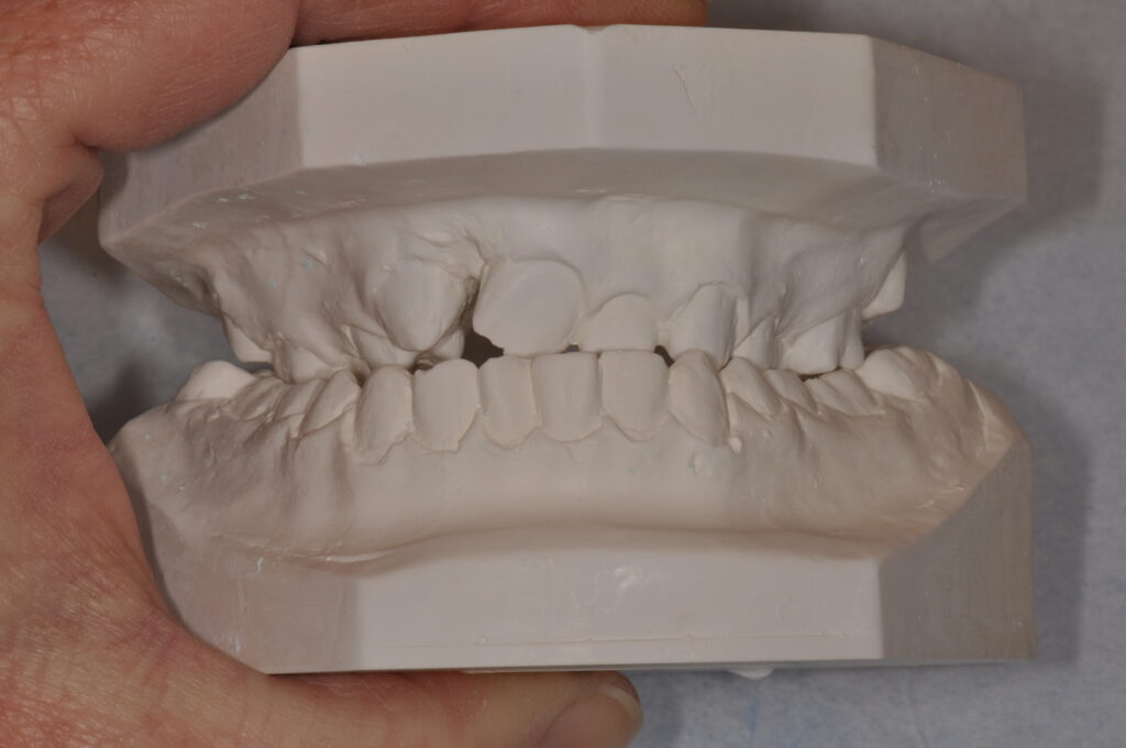 Gipsmodell av tänder.